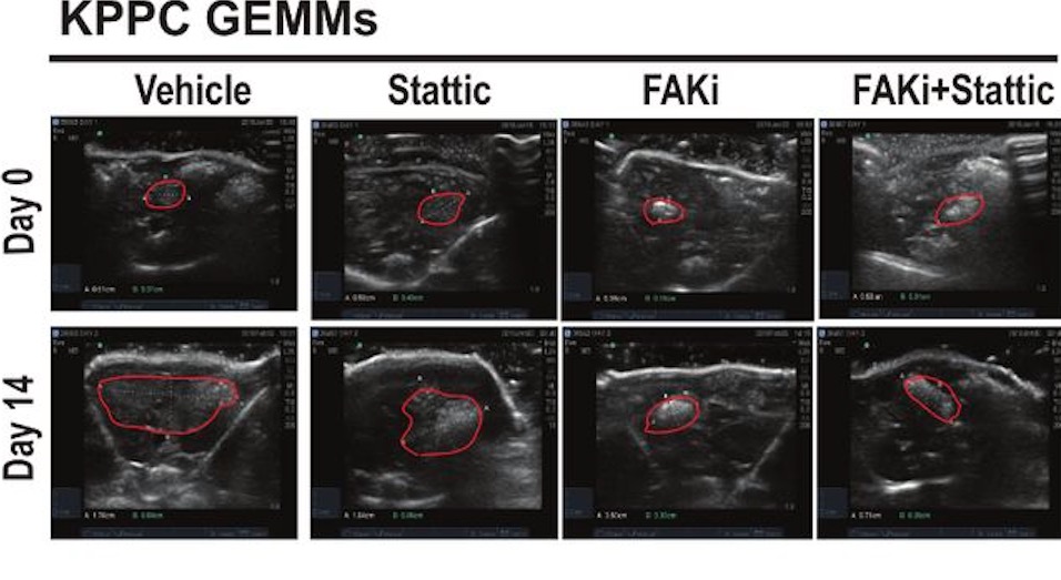 Development of resistance to FAK inhibition in pancreatic cancer is linked to stromal depletion