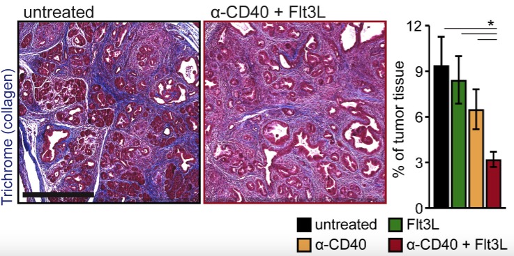 Dendritic Cell Paucity Leads to Dysfunctional Immune Surveillance in Pancreatic Cancer