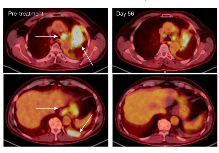 An IL-4 signalling axis in bone marrow drives pro-tumorigenic myelopoiesis